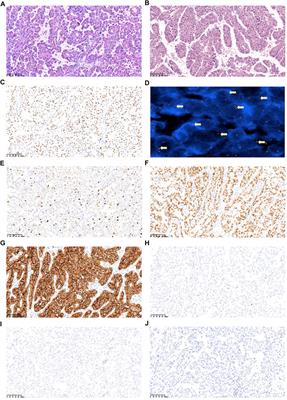 Case Report: Clinical complete response of advanced renal cell carcinoma associated with Xp11.2 translocation/TFE3 gene fusion by treated by camrelizumab and axitinib: A rare case report